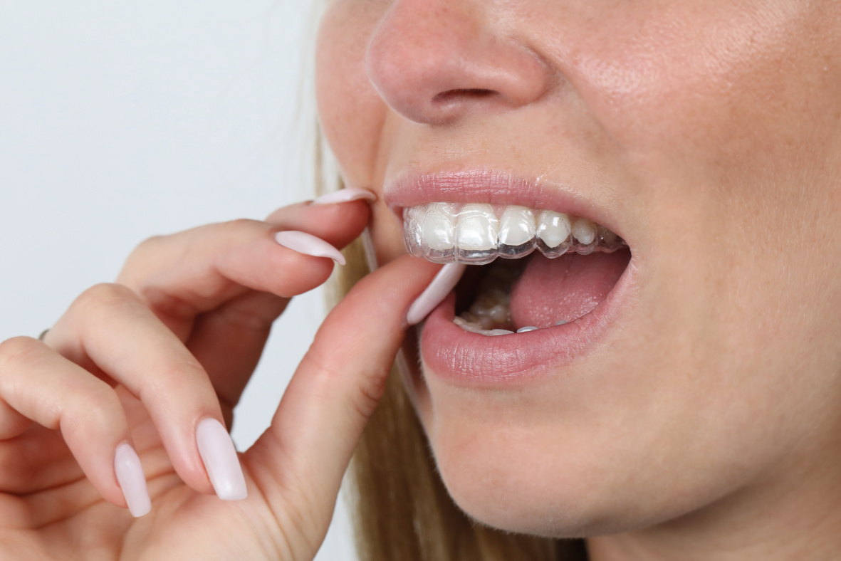 Clear-Aligner-Schienen